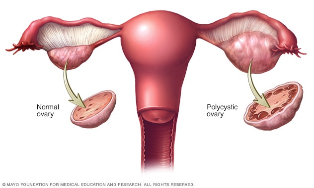 polycystic-ovarian-syndrome-pcos-is-a-common-endocrine-and