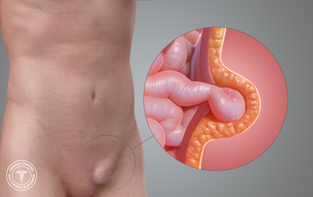 Patient Information on Inguinal Hernia | Apollo Clinic ...